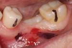 (6.) Marking the most facial aspect of the adjacent teeth and the mucogingival line with a permanent marker can help in determining the proper angulation of the implant and its eventual emergence profile.
