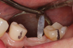 (7.) An Orban knife was used to make a precise incision slightly lingual to the center of the crest in order to harvest a band of attached gingiva that would later be repositioned to the facial aspect of a tall healing abutment. No vertical incisions were made into the mucosa. When incisions are limited to the attached gingiva, prostaglandins and histamine are not released, and thus, there is nominal postoperative discomfort for the patient.
