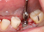 (11.) Following implant planning protocols, an osteotomy was made that would maximize the emergence profile. The selected implant (Hahn™ Tapered Implant, Glidewell) was positioned in the center of the ridge in line with the central grooves of the adjacent teeth.
