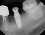 (14.) An intrasurgical radiograph was acquired to assess the final position of the implant and healing abutment.