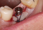 (18.) A periodontal sling suture was used to reposition the band of attached gingiva on the buccal flap from the slightly lingual aspect of the crest to the facial aspect of the healing abutment. To accomplish this, a reverse cutting, 3/8-circle needle was engaged on the mesial-facial aspect of the attached gingiva. After the suture was wrapped around the healing abutment without engaging the lingual tissue at all, the needle was reversed, engaging the distal-facial aspect of the attached gingiva, and again the suture was wrapped around the healing abutment without engaging the lingual tissue. A knot was tied on the mesial facial aspect. The exposed bone at the crestal aspect of the site was left untouched. Epithelium will fill that space at a rate of approximately 0.5 mm per day.