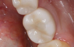 (25.) Occlusal and buccal views of the final implant crown (BruxZir® Zirconia, Glidewell) demonstrating excellent periodontal health.