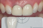 Fig 2. Using composite resin to mimic discolored preparations and create an accurate shade match.