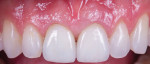 Fig 7. One approach to masking discolored dentition involves using a semi-translucent restoration with a semi-translucent resin cement.