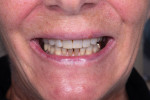 Fig 8. Pre-operative photographs of a patient who had severe tetracycline stains and wanted a brighter, whiter smile.
