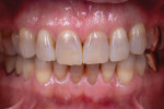 Fig 9. Pre-operative photographs of a patient who had severe tetracycline stains and wanted a brighter, whiter smile.