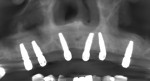 (11.) A panoramic radiograph was acquired following implant placement to document the position and angulation of the implants prior to immediate loading with the provisional hybrid prosthesis.