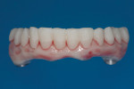 Fig 18. The bar was bonded into the denture, the intaglio was established, and a
highlight red resin was applied to mimic the gingival coloration in a simplified pink coloring protocol.