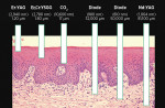Fig 1. Laser–tissue interactions in the oral mucosa using different
laser wavelengths. (Reprinted with permission from Advanced Laser
Surgery in Dentistry (2021), edited by Georgios E. Romanos, published
by John Wiley & Sons, Inc.)