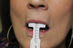 Figure 2  The papillameter is a valuable tool for measuring the patient’s lip positions. The patient’s low lip line is shown here in resting position.