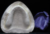 Figure 10  Combination of addition of maxillary lingual contour and mandibular incisal length.