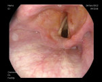 Fig 4.
Endoscopic
view after
removal of
the foreign
body.