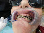 Fig 1. A cancer patient at high risk for caries has been treated with biannual applications of SDF to preserve dentition since 2014 (photograph courtesy of Dan Bentley, DDS).