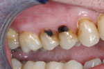 Fig 3. This adult patient with a previous history of drug use was compliant with oral hygiene instructions and received two applications of SDF on cavitated lesions. The buccal lesions on teeth Nos. 4 and 5 have arrested, as evidenced by darkening and hardening of dentin. (This image was originally published in: Young DA, Quock RL, Horst J, et al. Clinical instructions for using silver diamine fluoride (SDF) in dental caries management. Compendium of Continuing Education in Dentistry. 2021 June;42(6). Copyright © 2023 to BroadcastMed LLC. All rights reserved. Used with permission of the publisher.)