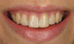 (1.) Pretreatment smile photograph of a 19-year-old female patient with a high smile line and visibly discolored composite restorations on teeth Nos. 7 through 10.