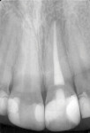 (2.) Pretreatment periapical radiograph exhibiting the large composite restorations and recently completed endodontic treatment on tooth No. 9.