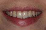 (3.) Posttreatment smile photograph acquired after four bonded porcelain restorations were placed on teeth Nos 7 through 10. During a recall appointment, a vertical root fracture was discovered on tooth No. 10, which the patient wanted to replace with an implant-supported restoration.