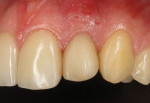 (6.) Four-week postoperative photograph of the tooth No. 10 site demonstrating soft tissue stabilization with uneventful healing.