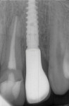 (12.) Radiograph of the definitive restoration acquired 6 months after delivery.