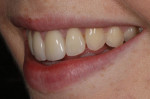 (14.) Left lateral smile photograph of the definitive restoration 6 months after delivery.