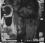 Figure 2  MRI of left TMJ in closed position. Note 9 o’clock disc and effusion present.