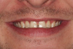 Figure 2  A preoperative view of the patient’s smile showed severely worn maxillary dentition on teeth Nos. 6 through 11 and a reverse smile line.