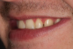Figure 3  A right side view of the patient’s smile.