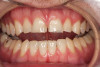 Figure 31   Technical precision and artistic skill blend into a pleasing smile and a happy patient.