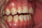 Figure 5  A preoperative retracted view of the left side of the patient’s dentition.