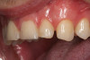 Figure 3  Image demonstrating deep overbite in which shear and tensile stresses would be at least medium. Bonded porcelain would require maintenance of enamel and an occlusal strategy to reduce leverage on the teeth.