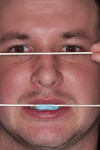 Figure 9  An eyebrow-to-chin photograph of the stick bite, with the patient holding a horizontal stick across his eyes.