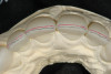 Figure 7  Preoperative photograph of an inlay in tooth No. 18 and an onlay on tooth No. 19.
