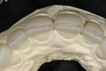Figure 11  The facial incisal edge was marked with a red pencil, while a 0.3 mm lead pencil was used to mark a 0.5 mm line lingually, which indicated the need for a facial reduction.