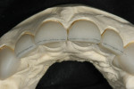 Figure 12  The 0.5 mm facial reduction was accomplished using a Komet K6974 220 centered diamond disc bevel.
