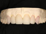 Figure 14  The finalized cut-back to the lithium-disilicate restorations.