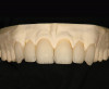 Figure 11  Preoperative photograph of a case in which the patient refused surgery and orthodontics. The treatment goal was to do minimal preparation and use a tough material due to general medium-to-high risk in every area—obtaining a seal was possible.