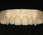 Figure 15  Using universal stains, the high- and low-value details that are typically found in the internal structure of a natural tooth were emulated in the restorations.