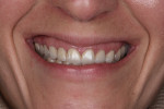 Fig 2. Pretreatment
close-up view of the patient’s Duchenne smile.