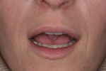 Fig 3. Pretreatment
close-up view of the patient in repose. Note attrition of the mandibular
teeth and proper display of the maxillary central incisors.