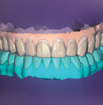 Fig 7. The design of the 3D wax-up. The original scan was merged
with a scan after the flowable composite was placed at the proposed
gingival margin.