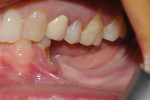 Fig 1. Atrophy of the edentulous jaw distal to hopeless tooth No. 21.
