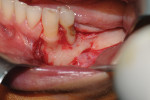 Fig 3. Full-thickness flap distal to tooth No. 22 and mental nerve isolation.