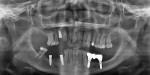 Fig 8. Panoramic radiograph, 4-months
post-surgery, showing prosthetic bridge.