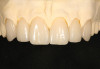 Figure 17  Postoperative photograph of teeth Nos. 18 to 20 in a case with subgingival margins. Photograph courtesy of Yi-Yuan Chang.
