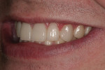 Figure 23  A right-side view of the patient’s postoperative smile.