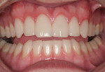 Figure 25  A retracted postoperative view of the patient’s smile makeover.