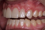 Figure 26  A right-side view of the patient’s retracted postoperative smile.