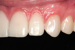Figure 28  The patient’s smile in a right-side retracted close-up.