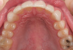 Figure 30  A postoperative photograph of the patient’s maxillary arch.