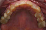 Figure 3  Preoperative occlusal view.